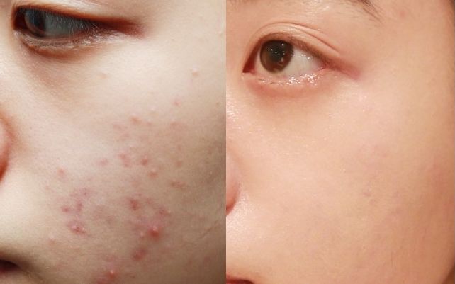 臉上長痘的原因有哪些