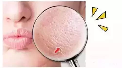 毛孔粗大怎么辦？毛孔粗大的解決方法