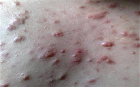 什么是痤瘡，什么是粉刺？痤瘡和粉刺有啥區別？