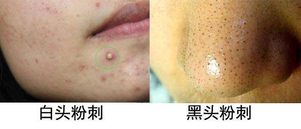 什么是痤瘡，什么是粉刺？痤瘡和粉刺有啥區別？