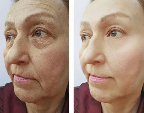 臉部松弛下垂如何改善？面部松弛下垂改善方法！