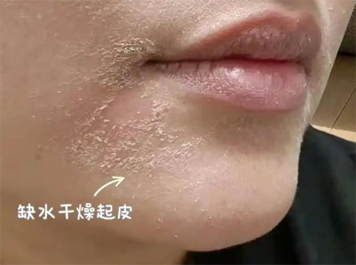 臉部脫皮干燥脫屑 臉部脫皮干燥脫屑是怎么回事?