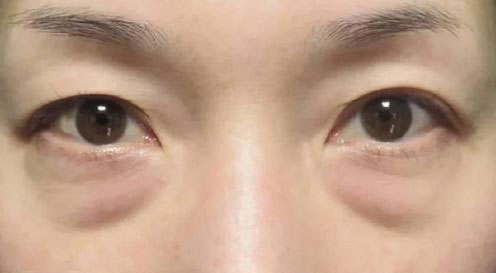 眼袋怎么治療才能徹底消除？