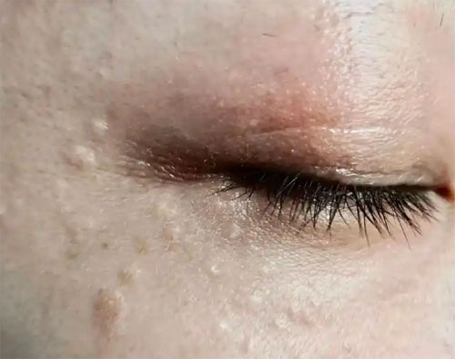 脂肪粒怎么樣才能去除？去除脂肪粒的方法