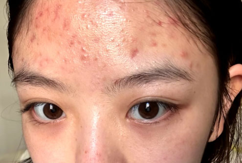 油痘肌怎么改善？油痘肌的改善方法有哪些？